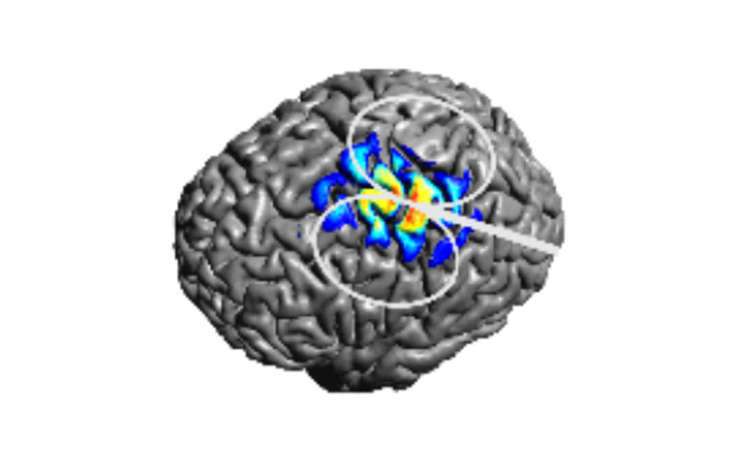 Tutorial: E-field modeling with simNIBS